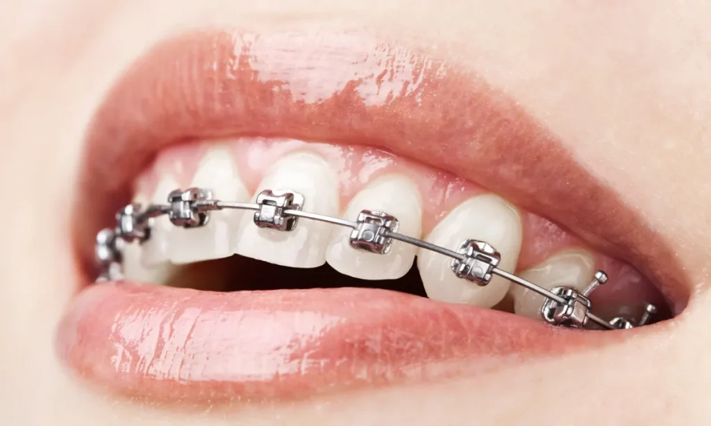 Harga Behel Damon Terbaru: Cek Biaya & Keunggulannya Disini! 9 Harga Behel Damon Terbaru Cek Biaya & Keunggulannya Disini! - Edental