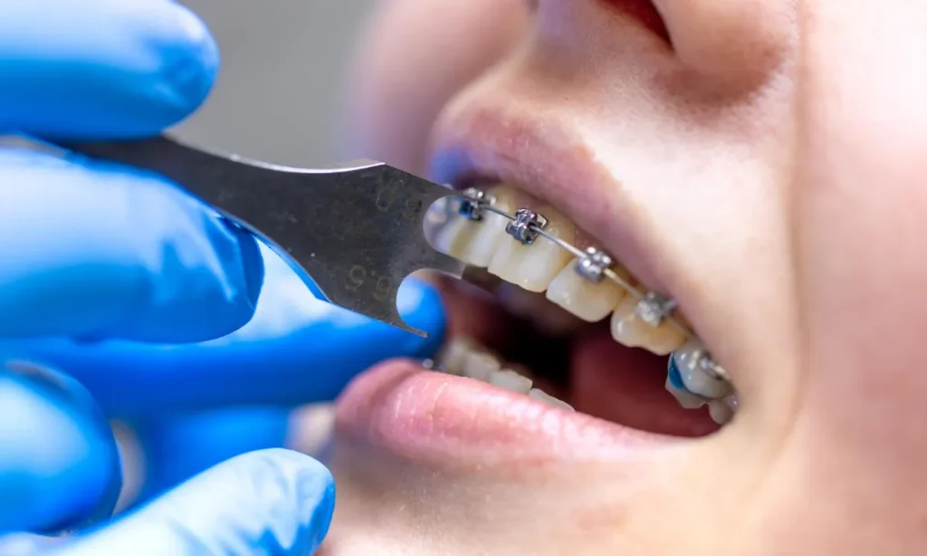 Apakah Pasang Behel Sakit? Simak 4 Fakta, Tips dan Alasannya 4 Apakah Pasang Behel Sakit Simak 4 Fakta, Tips dan Alasannya - Edental
