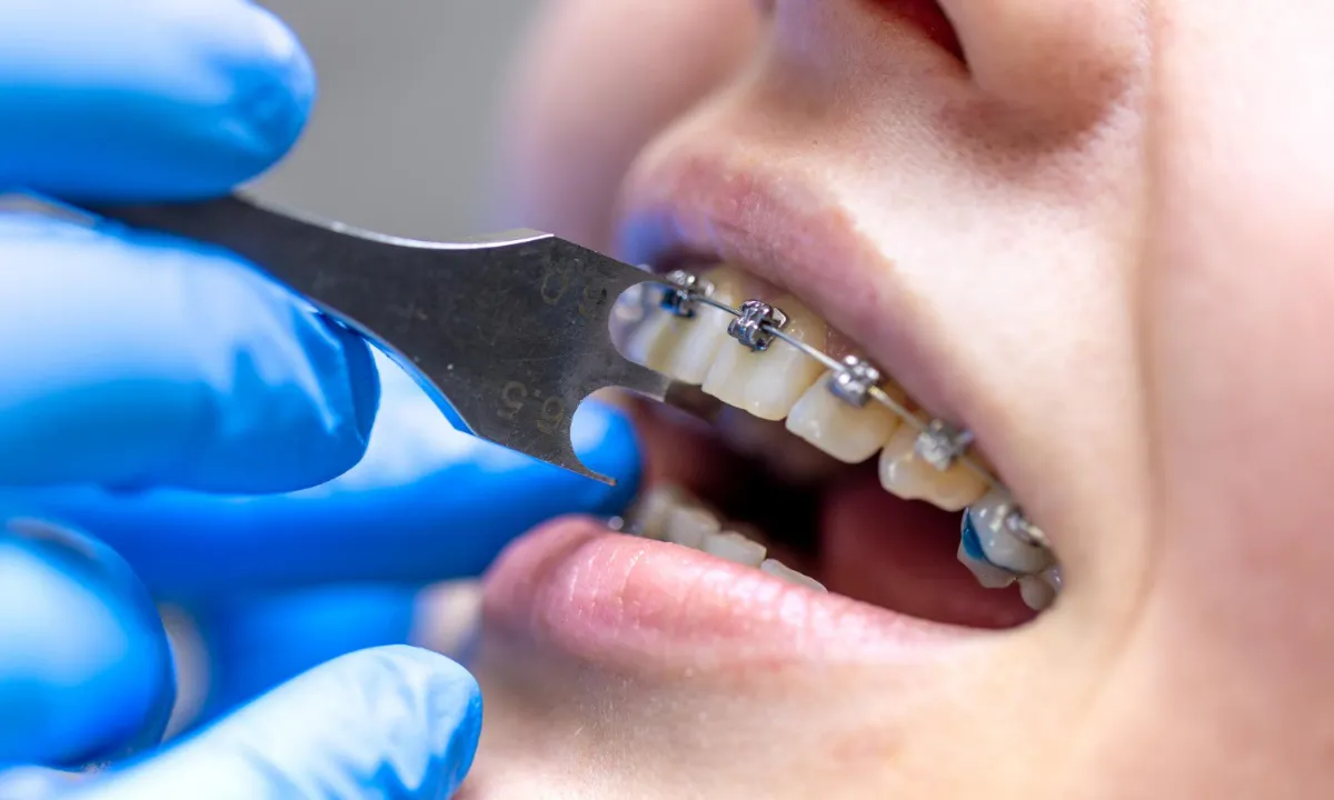 Apakah Pasang Behel Sakit Simak 4 Fakta, Tips dan Alasannya - Edental