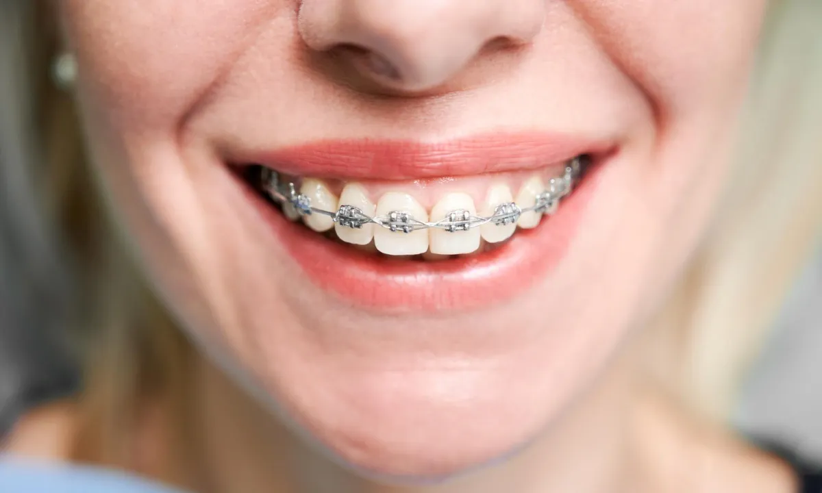 Behel Konvensional 5 Kelebihan, Durasi dan Proses Perawatan