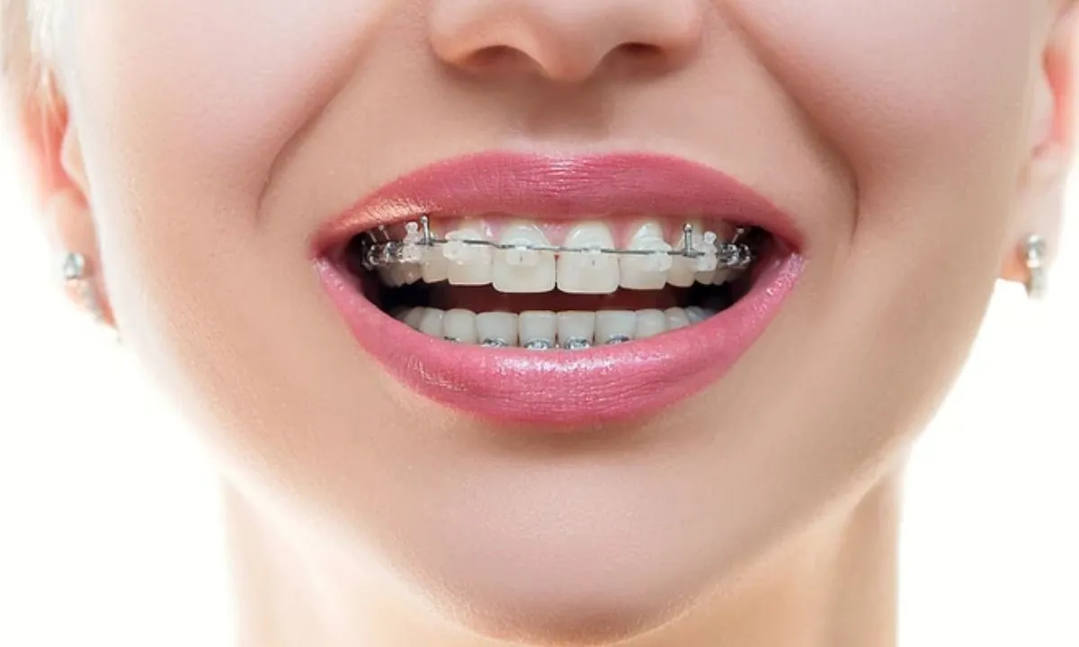 Gambar Ilustrasi Bracket Keramik (Ceramic Braces)