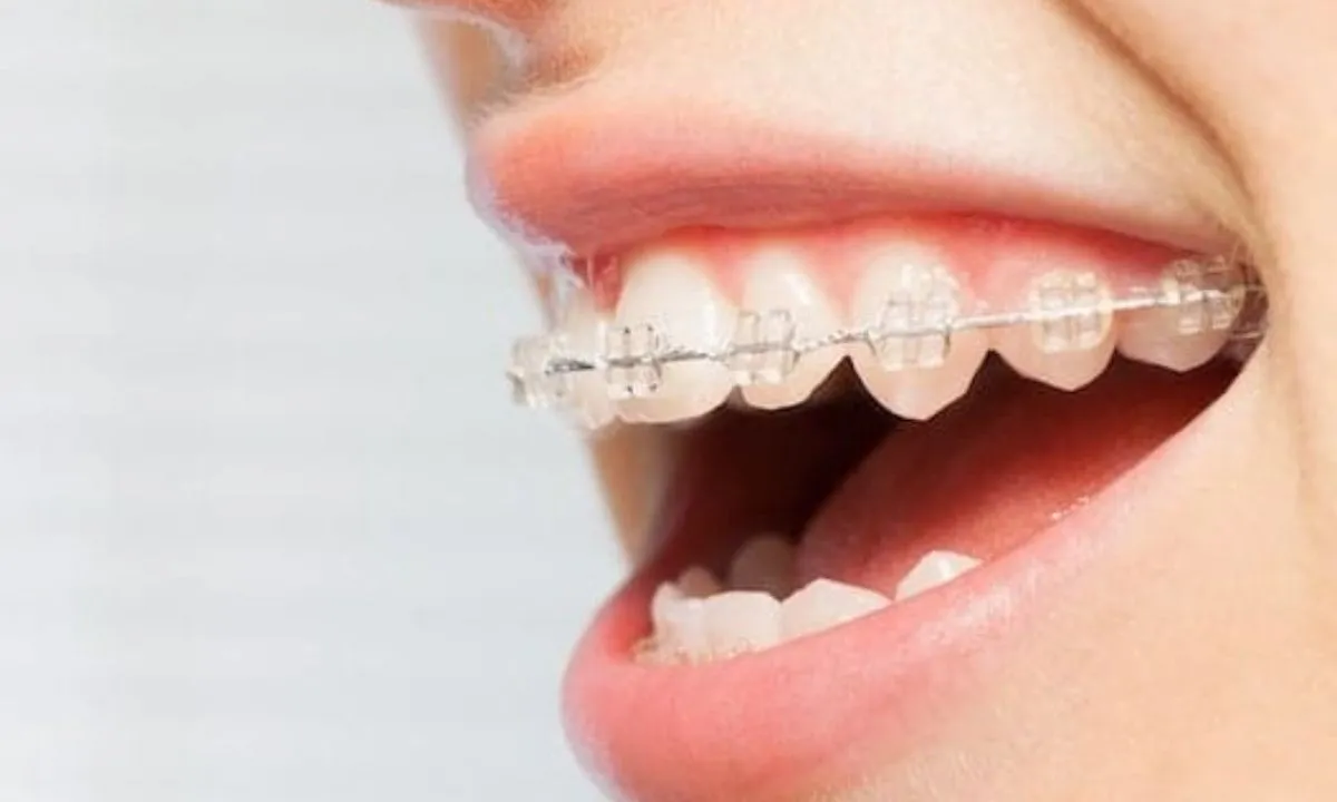 Gambar Ilustrasi Bracket Komposit (Composite Braces)