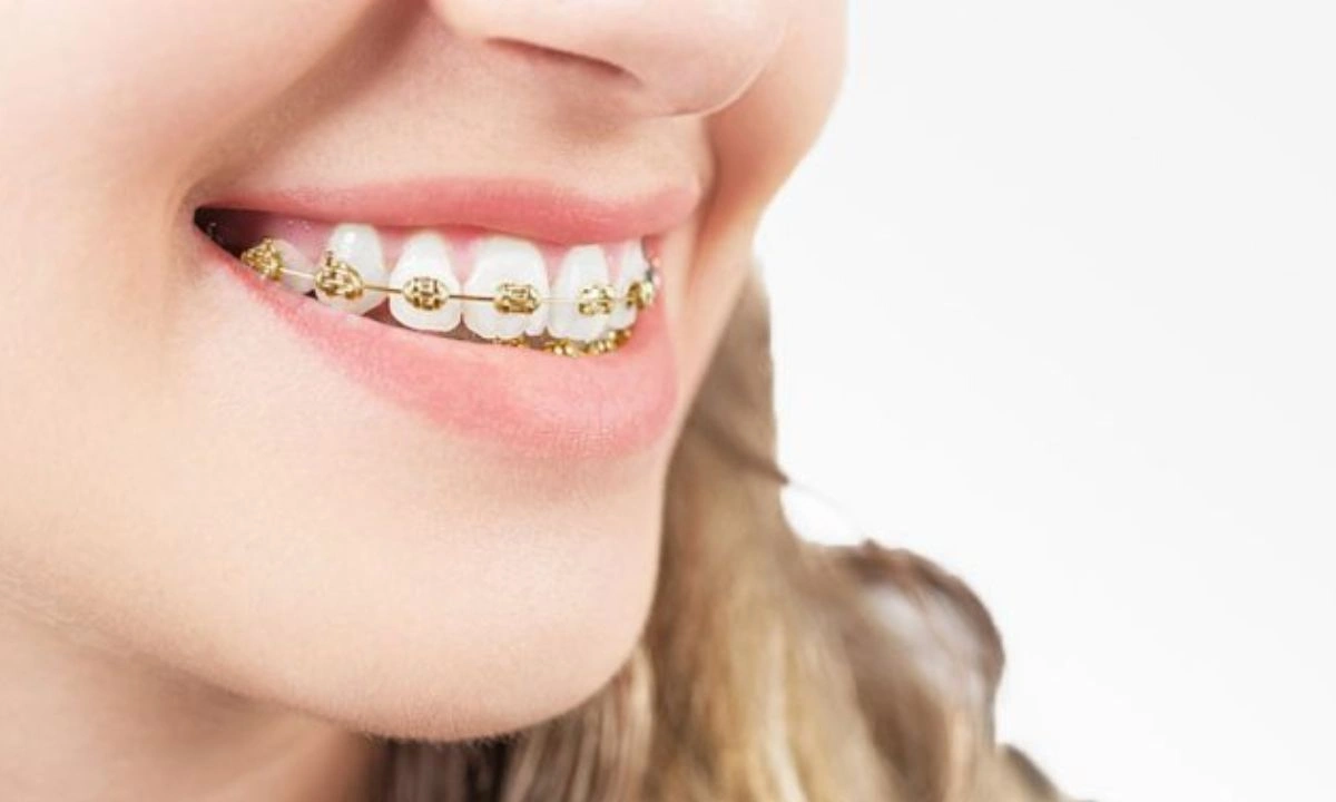 Gambar Ilustrasi Bracket Emas (Gold Braces)