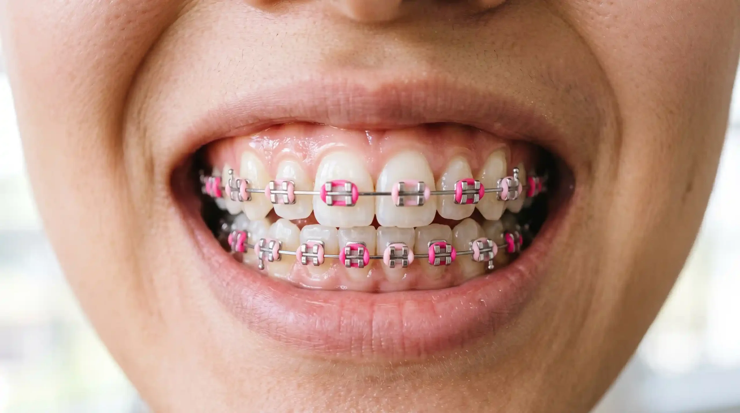 Warna Behel yang Lagi Trend Cerah untuk Tampil Playful Baby Pink & Hot Pink