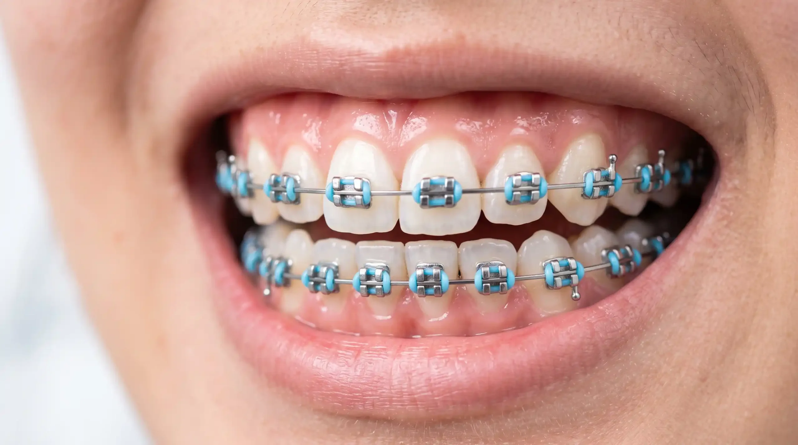 Warna Behel yang Lagi Trend Cerah untuk Tampil Playful Light Blue (Biru Muda)