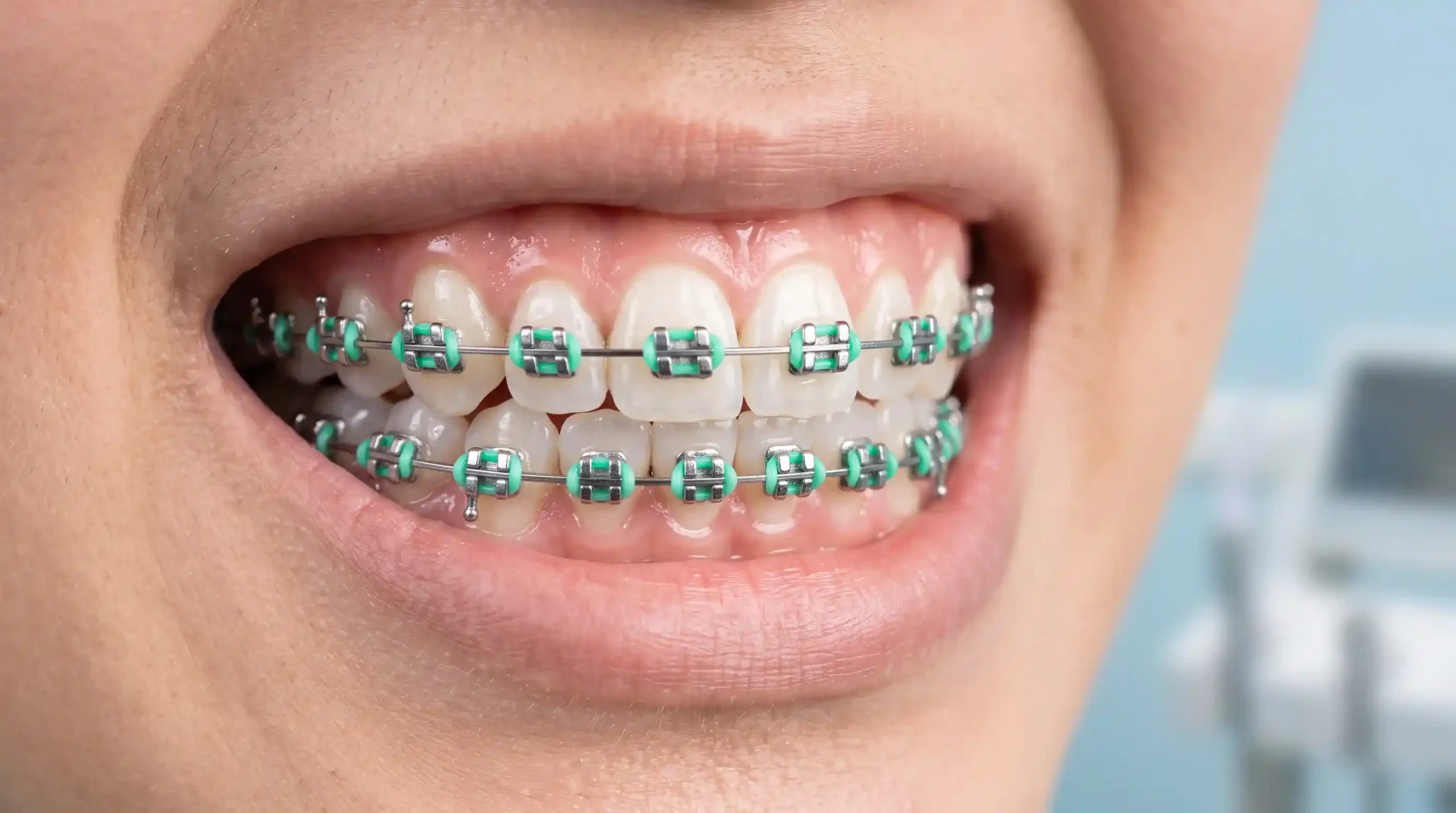 Warna Behel yang Lagi Trend Cerah untuk Tampil Playful Warna Behel Mint atau Hijau Tosca